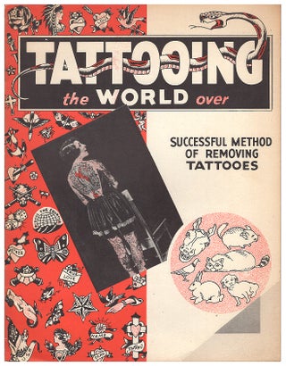 Tattooing the World Over: Successful Method of Removing Tatooes